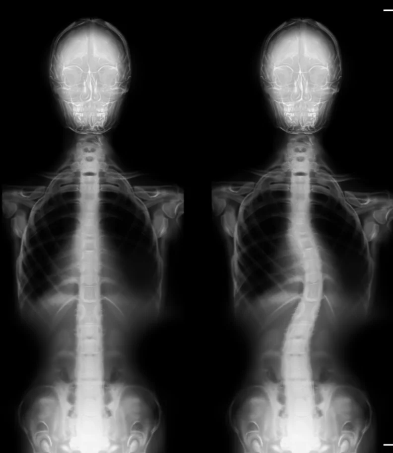 scoliosis Heath TX